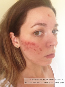 Chemical burn from a beauty product that had gone bad.